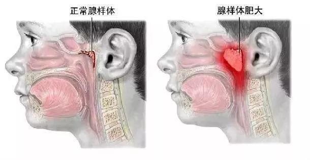 腺样体肥大的宝宝为什么这么多？_宝宝疾病-儿童护理