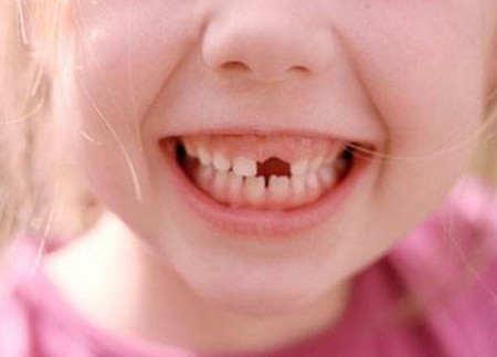 2岁宝宝不吃糖却一口烂牙是怎么回事_牙齿护理-牙齿-宝宝2岁-儿童护理