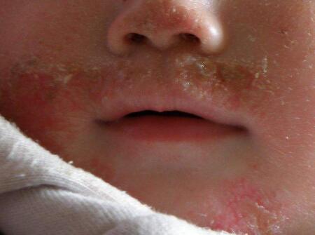 婴儿口周湿疹的症状_儿童护理-0-1岁瘙痒-皮疹-渗出
