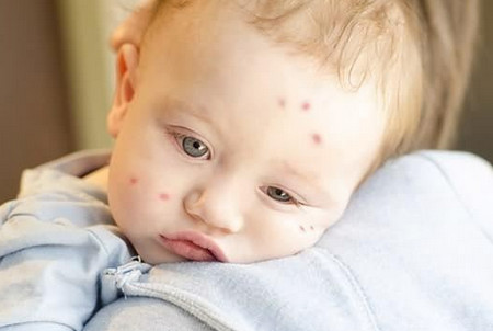 夏季防止宝宝被蚊咬，聪明妈妈都在用这招！_儿童护理叮咬-驱蚊-宝宝