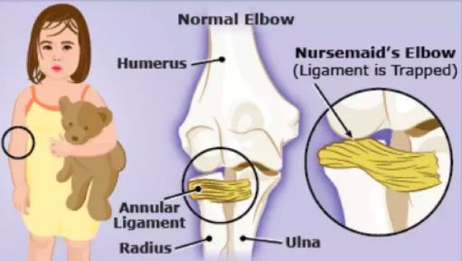 怎么判断孩子脱臼？脱臼后如何处理？_儿童护理手臂-肘部-伤害
