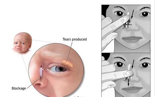 宝宝总是泪眼朦胧是上火了吗_儿童护理按摩-这种情况-通畅
