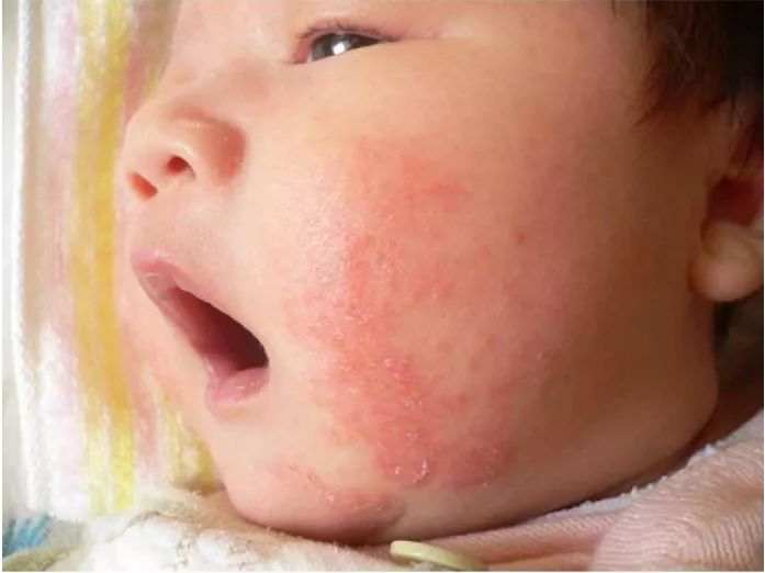 夏季湿疹、痱子频发，宝宝应该如何护肤？_痱子-儿童护理宝宝-涂抹-尿布