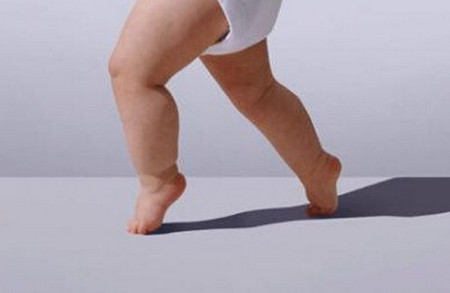 宝宝O型腿如何矫正？家长应该怎么做？_儿童护理发育-导致-骨骼