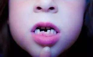 孩子换牙先换上面还是下面_儿童护理牙齿-顺序-恒牙