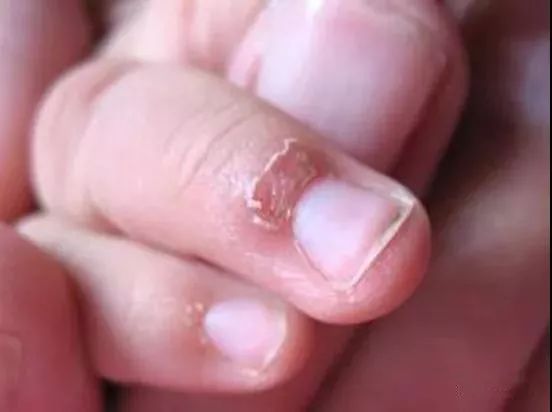 宝宝手指长倒刺是什么原因？_儿童护理原因-手指-用手