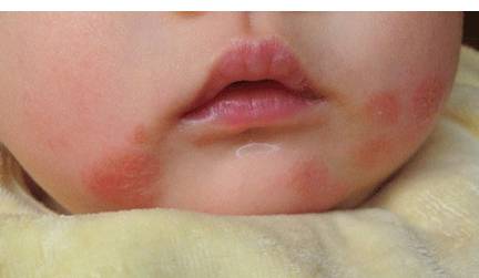 宝宝反复湿疹怎么办，如何治湿疹_儿童护理止痒-解决办法-好了