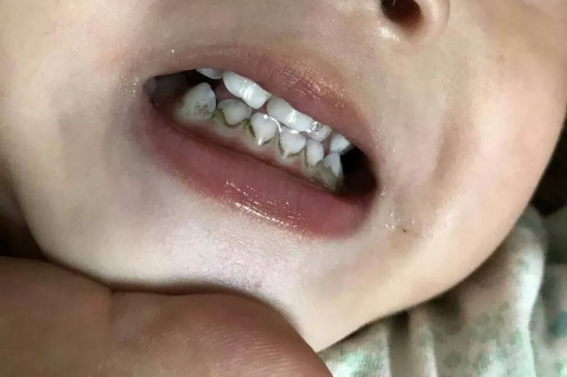 为什么宝宝牙齿越刷越黑_牙齿-刷牙-儿童护理宝宝-孩子-越来越