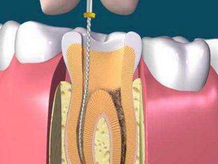 孕妇可以做牙齿根管治疗吗_怀孕护理牙髓-龋齿-孕期