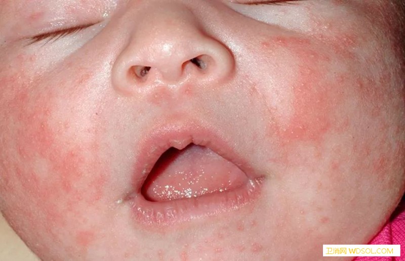 新生儿痤疮和湿疹区别是什么_丘疹-红斑-痤疮-湿疹-头部-婴儿-脓疱-
