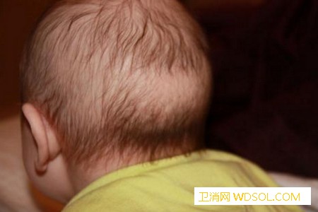 宝宝头上一圈枕秃怎么办_针眼-打了-头上-红肿-疫苗-维生素-缺钙-