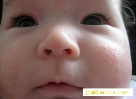 宝宝干燥性湿疹怎么办？_瘙痒-湿疹-水分-干燥-护理-角质层-皮肤-