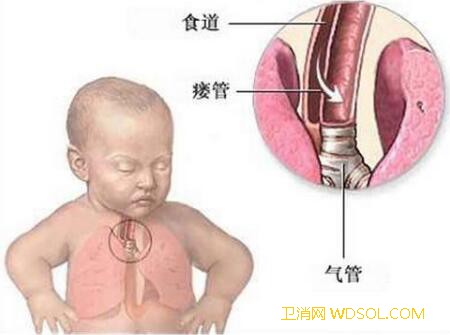 小儿气管支气管异物的症状_憋气-异物-支气管-较小-停留在-气管-声门-