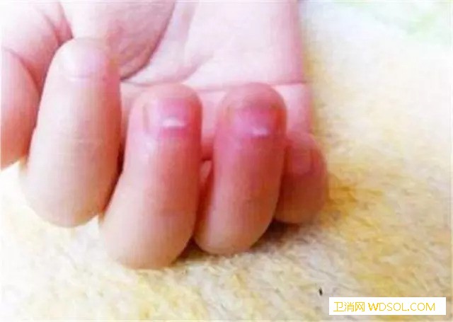 怎么看指甲异常判断宝宝健康状况_倒刺-白点-健康状况-指甲-