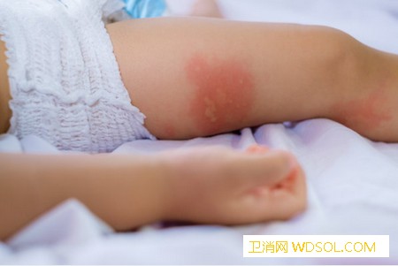 宝宝湿疹反复该怎么护理_营养元素-肠道-湿疹-皮肤-