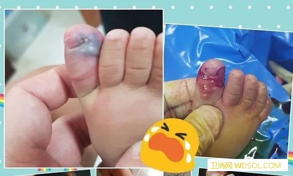 剪伤宝宝指甲有危害吗剪指甲需要注意这些_手指甲-修剪-指甲-婴儿-