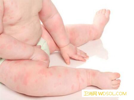 小儿干性湿疹怎么治疗_干性-组胺-软膏-润肤-