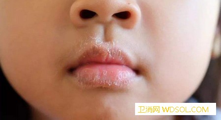 宝宝嘴唇容易干燥要怎么护理_尤其是-摄入-嘴唇-干燥-