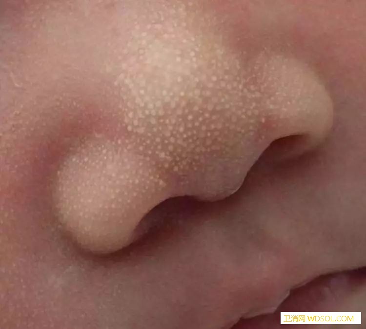 新生儿鼻子上长很多小白点是怎么回事_白点-上有-出汗-堵塞-