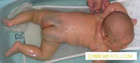 宝宝屁股上的青斑科学解释是什么_蒙古-屁股-出生-解释-
