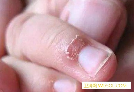 宝宝手上有倒刺真的是缺乏维生素吗？_倒刺-白点-指甲-妈妈-