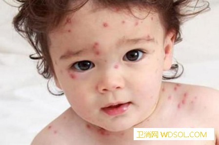 急疹、湿疹、风疹、水痘、幼儿各种疹子的症状及_风疹-皮疹-水痘-湿疹-