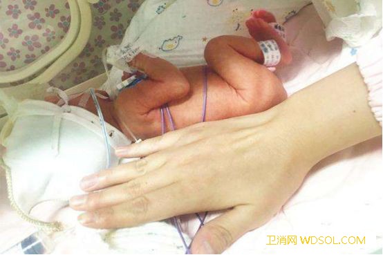 早产宝宝要住院吗_足月-早产儿-早产-出生-