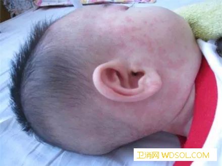 小儿常见皮肤病有哪些_疥疮-皮疹-水痘-红斑-