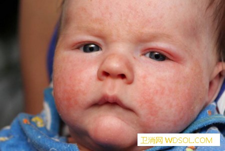 宝宝出现的结膜炎主要有哪些症状？_结膜炎-症状-宝宝-治疗-
