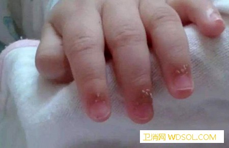 宝宝手指长倒刺是因为缺乏维生素吗？_倒刺-浸泡-指甲-手指-