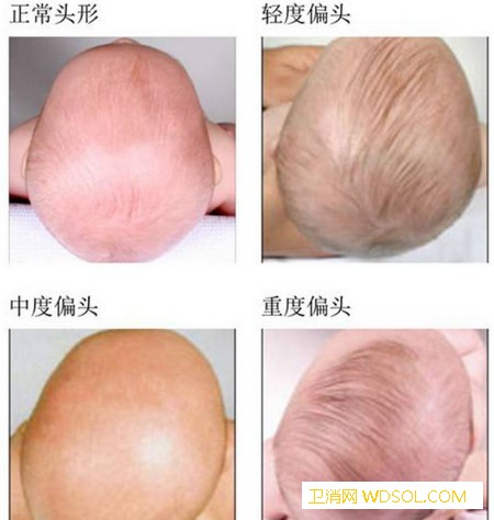宝宝头睡偏了如何预防_受压-头型-头骨-头部-