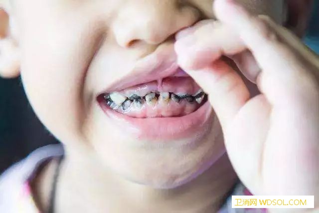 导致宝宝龋齿的原因_釉质-龋齿-蛀牙-牙齿-