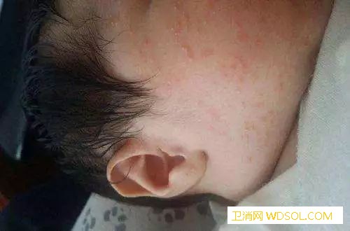 冬季湿疹高发期怎么办_抓挠-疹子-湿疹-误区-