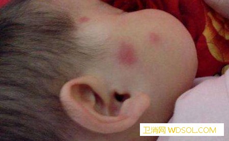 这些食物容易导致宝宝过敏！_蛋清-诱发-婴幼儿-症状-
