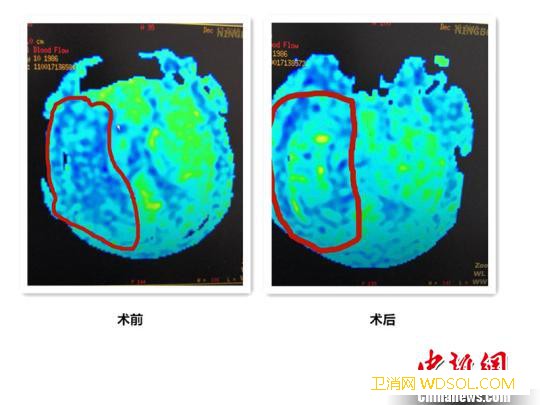 吃外卖、熬夜、少运动宁波32岁白领突发脑梗死_浙江大学-磁共振-脑梗死-定时炸弹