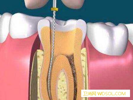 孕妇可以做牙齿根管治疗吗_牙髓-龋齿-充填-孕期-