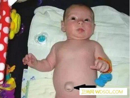 宝宝脐疝气怎么回事如何护理患脐疝的宝宝_凸出-凸起-肚脐-哭闹-