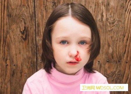 宝宝总流鼻血的原因有哪些_止血-流血-血管-流鼻血-