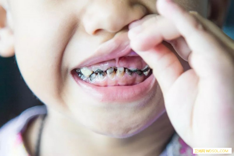 给牙齿涂氟可以预防牙龋坏吗_氟化-氟化物-龋齿-牙医-
