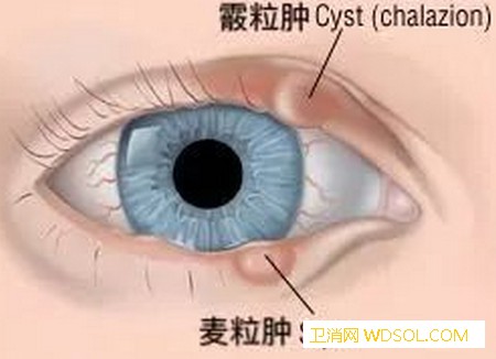 宝宝麦粒肿和霰粒肿怎么区分_麦粒肿-热敷-眼睑-肿胀-