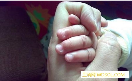 孩子手上长倒刺究竟是怎么回事_倒刺-上有-干燥-手上-