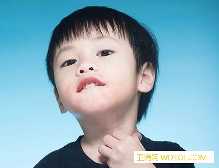 小儿水痘的10个常见问题_水痘-疫苗-传染-隔离-
