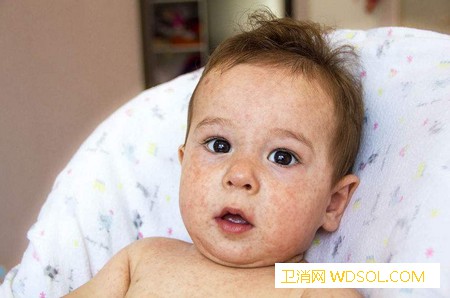 宝宝湿疹是什么原因引起的_湿疹-刺激-食物-导致-