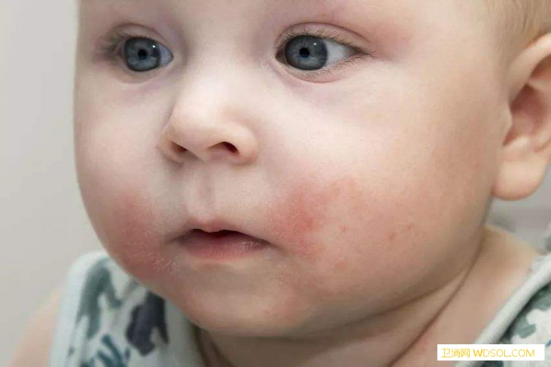 宝宝湿疹会传染大人么_湿疹-传染-刺激-食物-