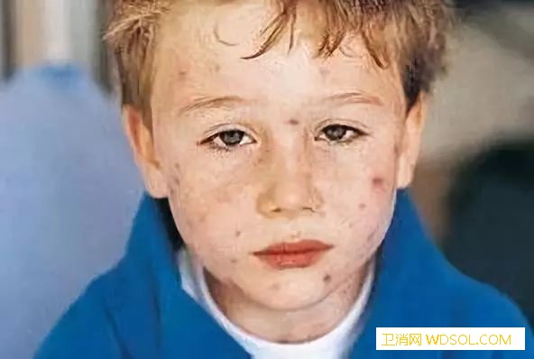 孩子皮肤出现小红疹是怎么回事_丘疹-皮疹-结痂-水痘-