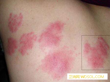 小儿季节性湿疹的症状_丘疹-结痂-季节性-渗出-