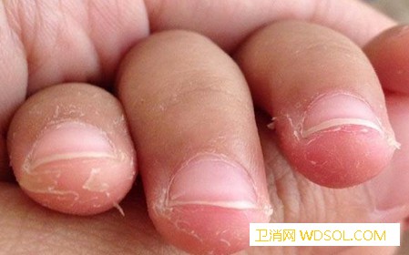 宝宝手指脱皮的原因和对策有哪些_猩红热-脱皮-手部-手指-