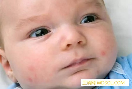 婴幼儿湿疹的护理方法_湿疹-婴幼儿-激素-护理-