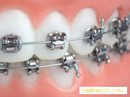儿童牙齿矫正器优缺点_优缺点-矫正-牙齿-隐形-