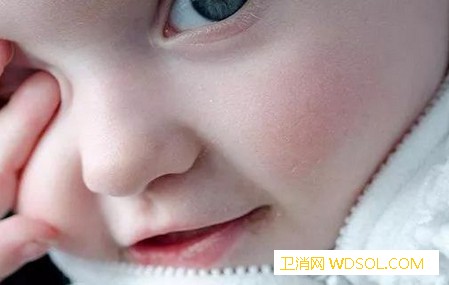 怎么防奶癣和湿疹_湿疹-喂养-牛奶-婴儿-